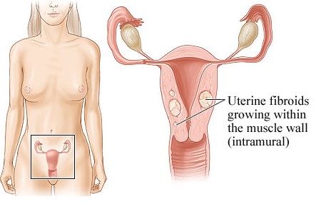 Fibroids Uterine